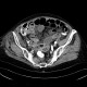 Mesenterial ischemia, gas in portal vein: CT - Computed tomography